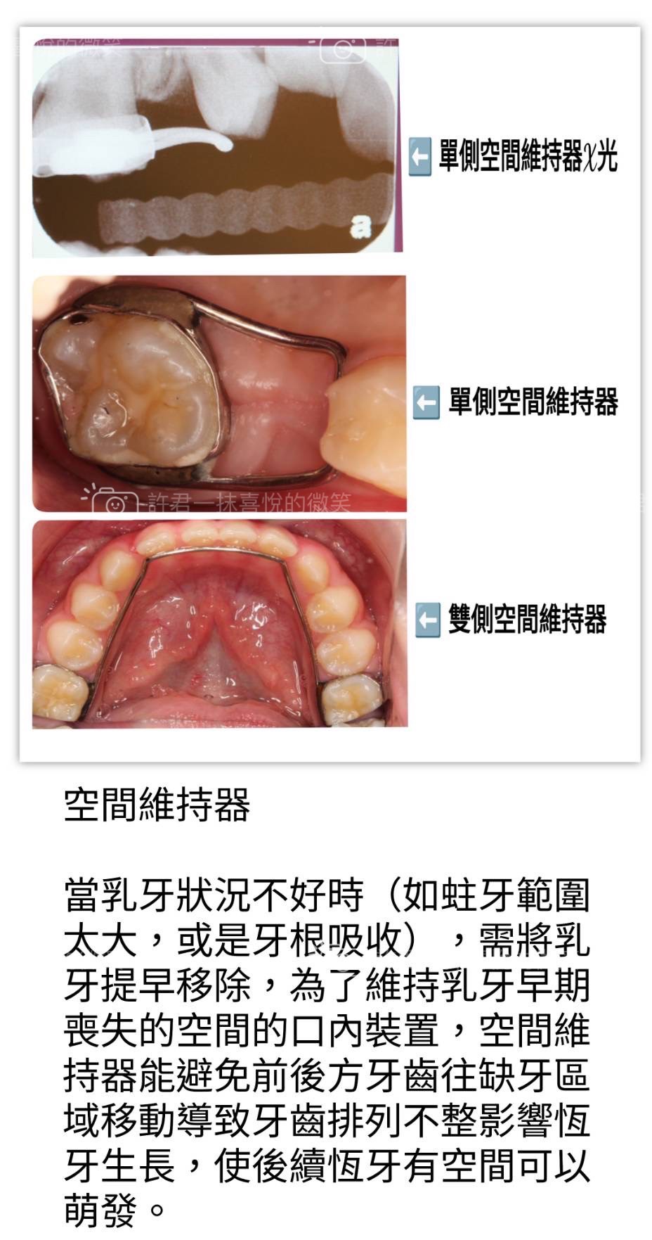 第一大臼齒是小朋友長的第一顆恆牙，用最久也是最容易蛀牙的牙齒