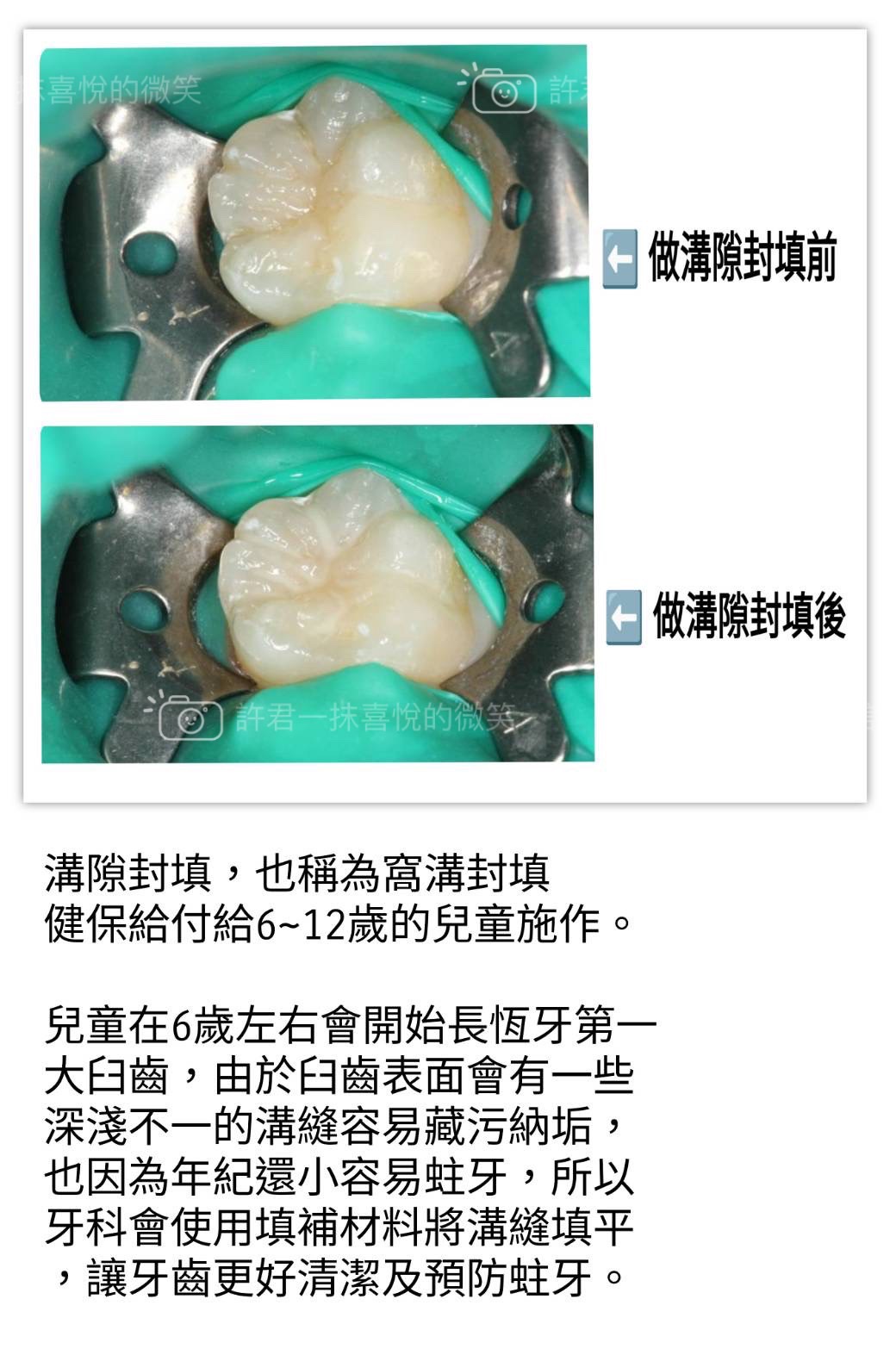 第一大臼齒是小朋友長的第一顆恆牙，用最久也是最容易蛀牙的牙齒
