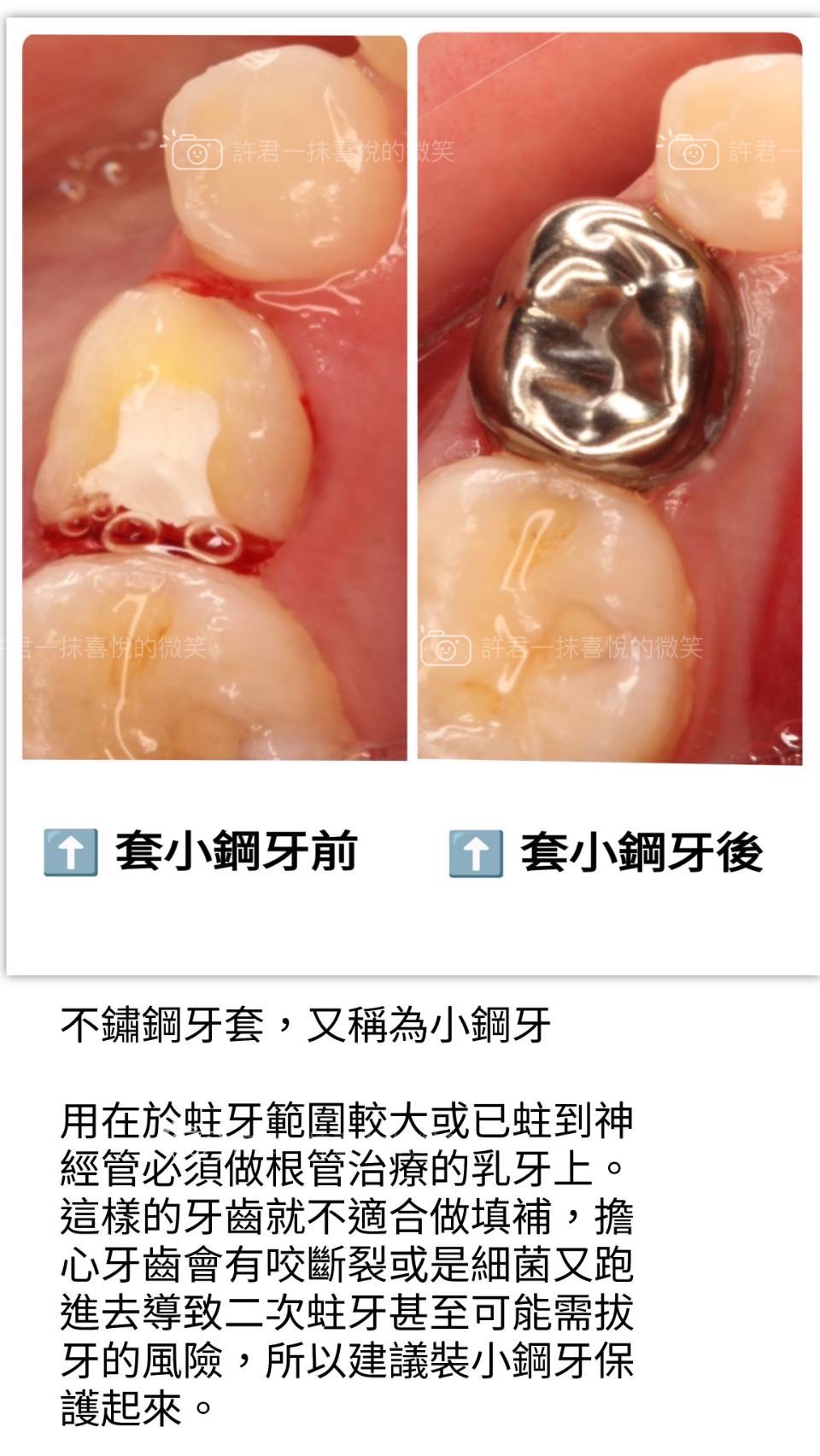 第一大臼齒是小朋友長的第一顆恆牙，用最久也是最容易蛀牙的牙齒