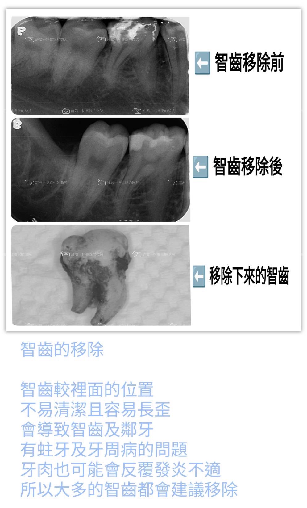 很少機會牙裂能夠被X光拍出來～！！！