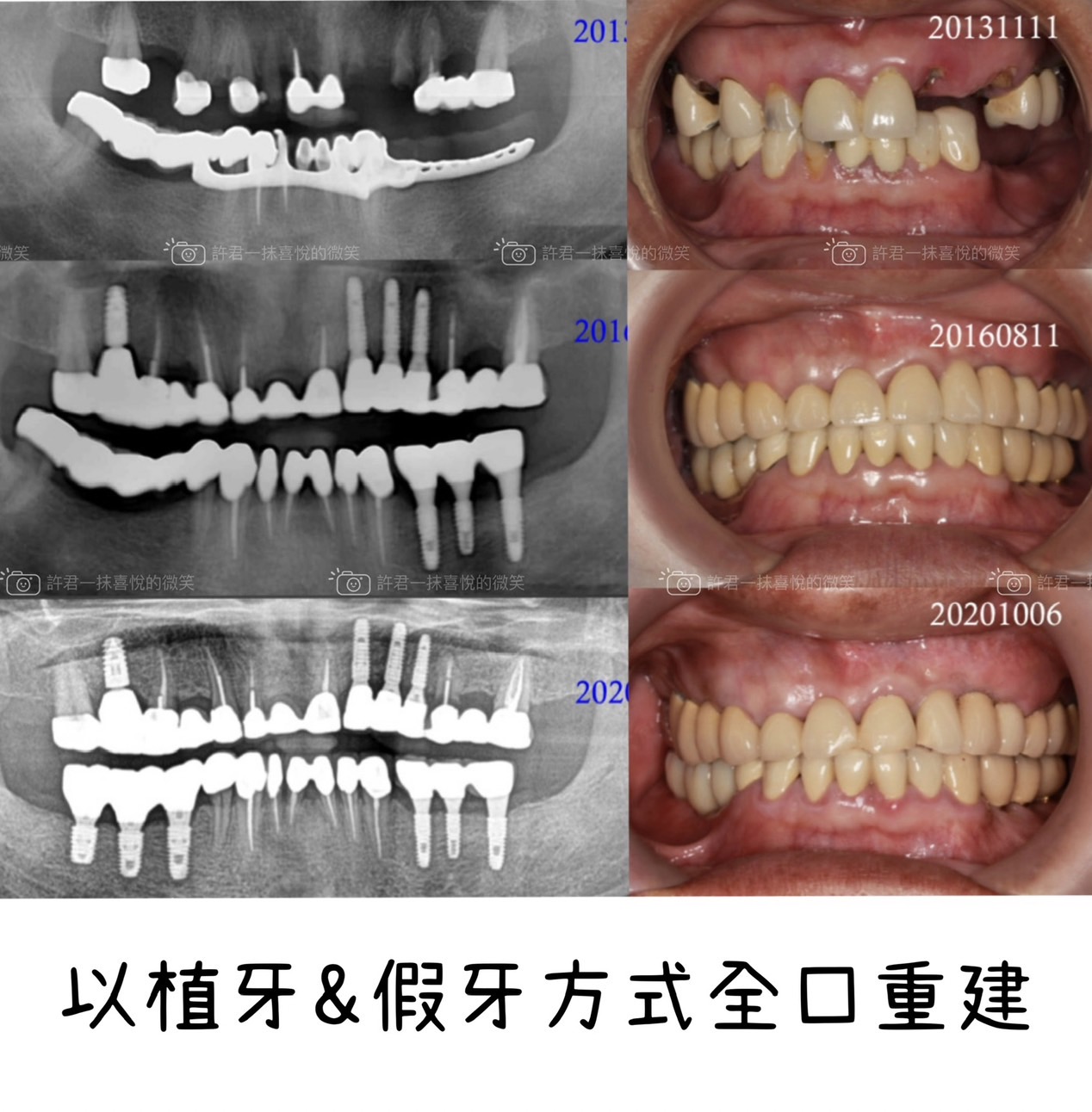 害怕手術，選擇做活動假牙