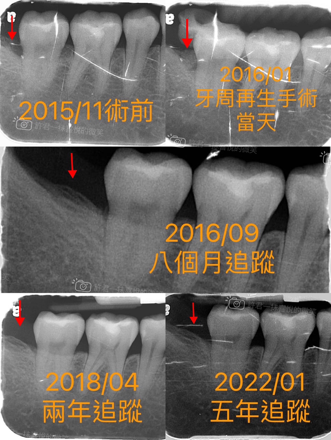 第二階段治療（牙周再生手術）