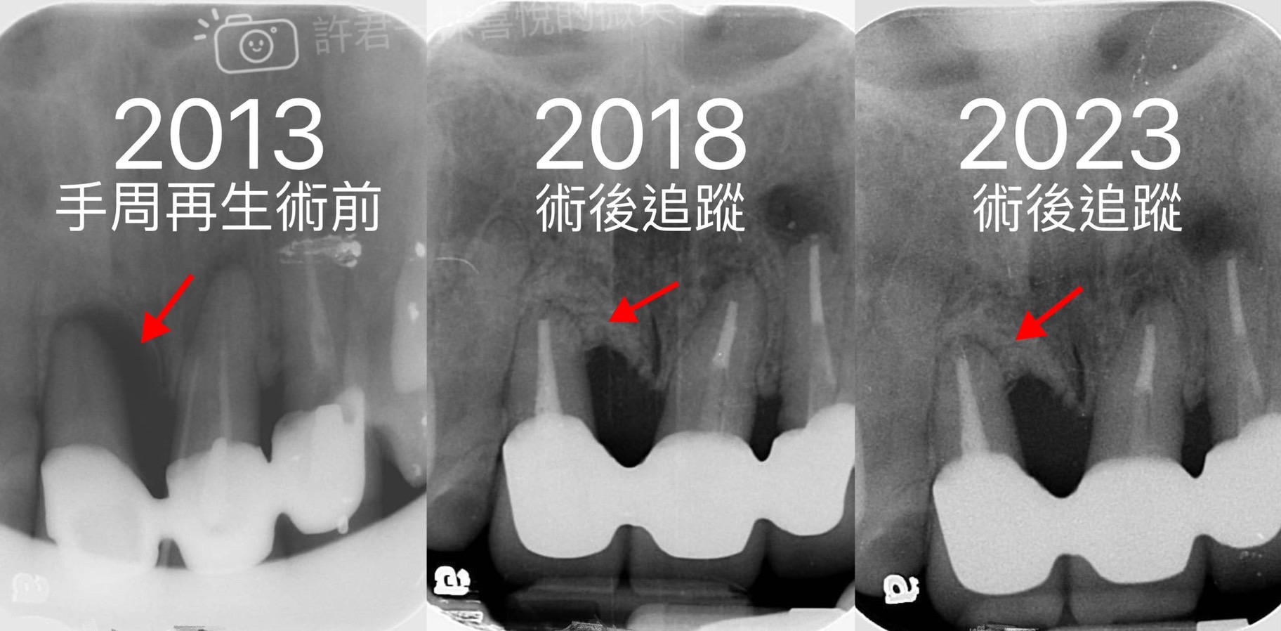 第二階段治療（牙周再生手術）