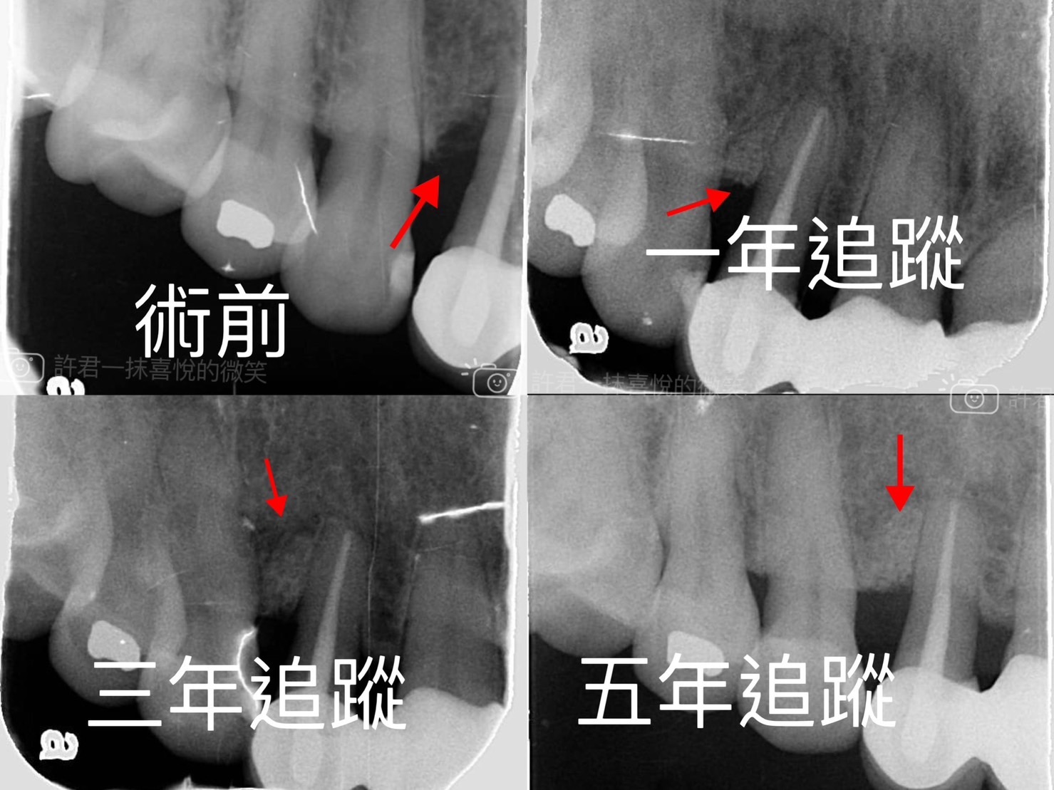 第二階段治療（牙周再生手術）