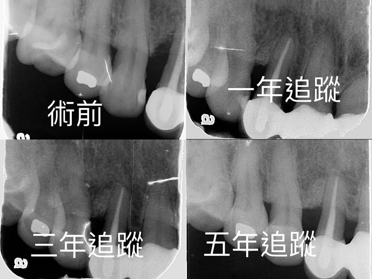 第二階段治療（牙周再生手術）