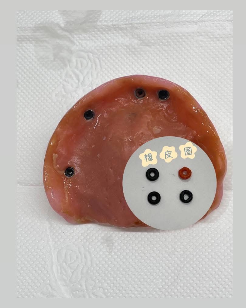 別以為只要完成活動假牙就萬事OK囉！