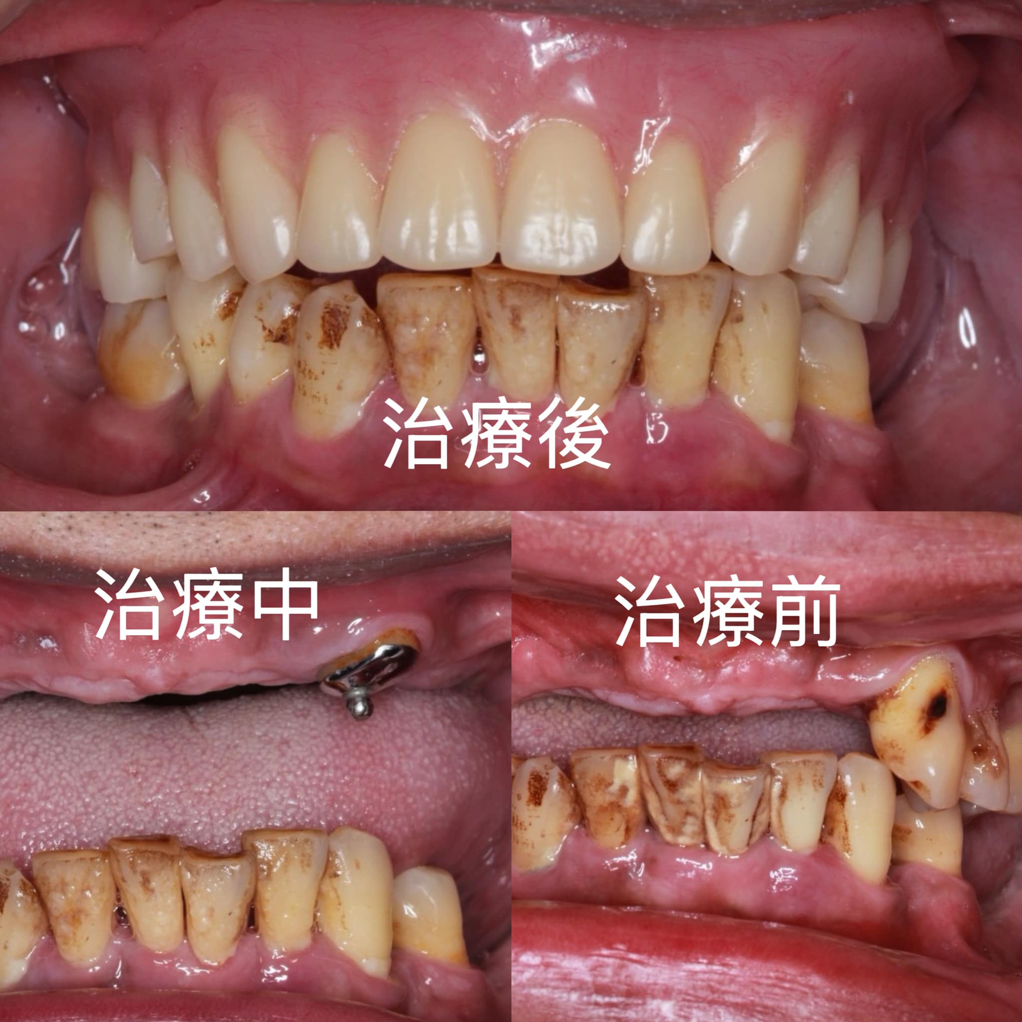害怕手術，選擇做活動假牙