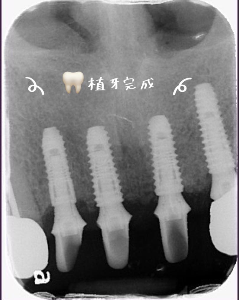 有聽說過透明牙冠嗎???