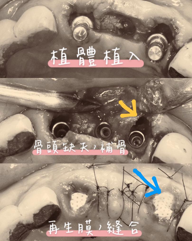 有聽說過透明牙冠嗎???