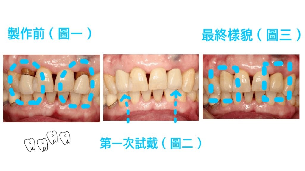 假牙美觀因人而異 你喜歡哪一種呢？