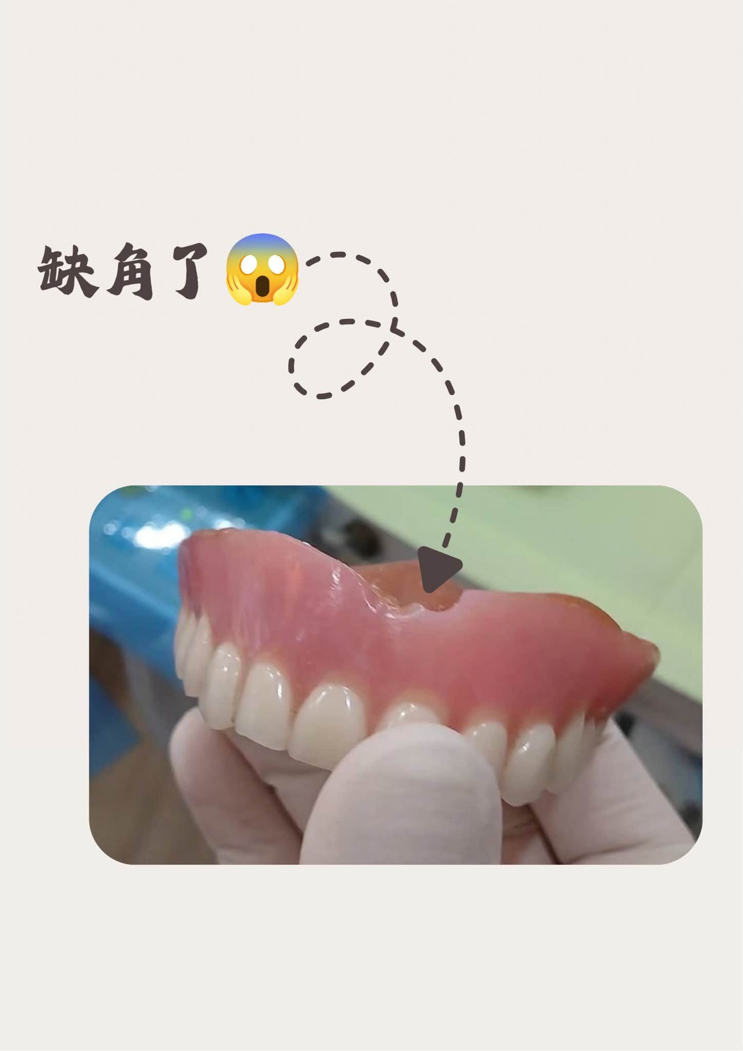 你知道活動假牙也會受傷嗎？