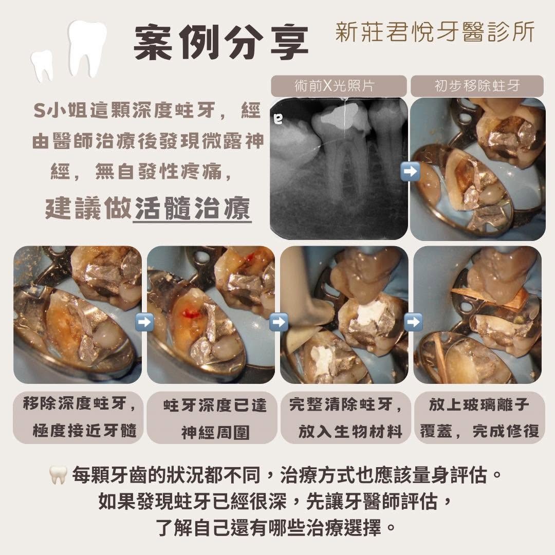蛀牙了,就一定要做根管治療嗎?